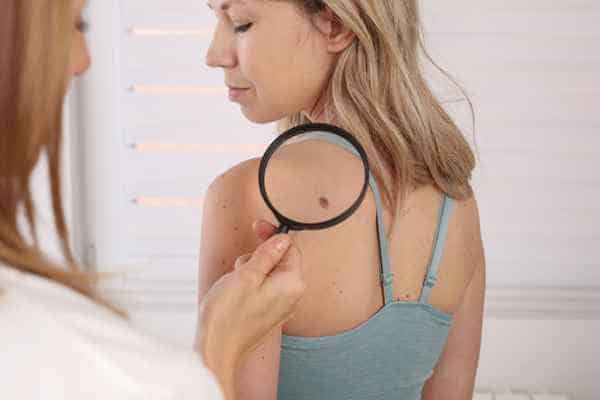 What Are Traditional Skin Lesion Removal Methods Chigwell?