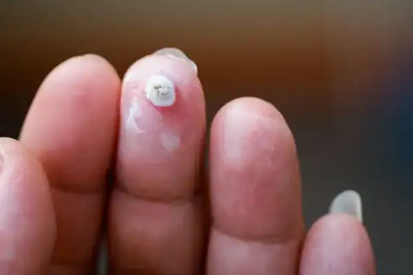 Image of white wart before cryopen treatment Chigwell