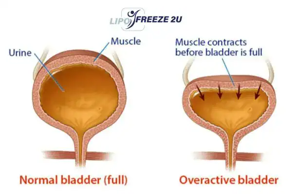diagram of overactive bladder treatment Chigwell