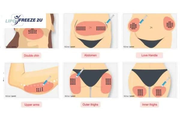 Benefits of Choosing Aqualyx for Fat Reduction Chigwell