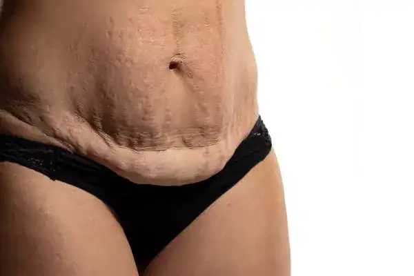 loose skin after weight loss injections Chigwell