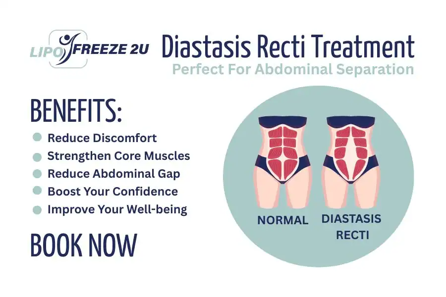 How Long Will It Take to See Improvements in Diastasis Recti Chigwell