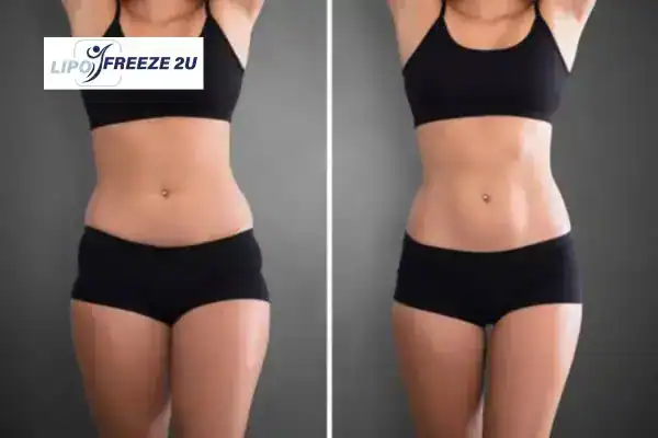 How Can LIPO FREEZE 2U Support Your Post-Pregnancy Body Recovery Chigwell?