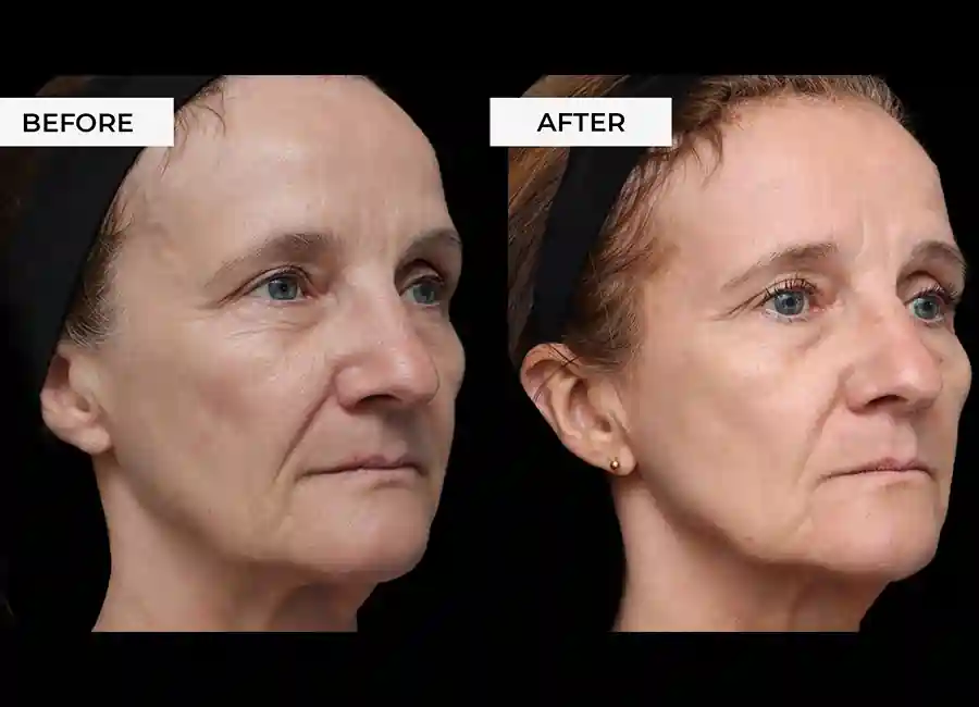 How Many RF Microneedling Sessions Will You Need to See a Difference Chigwell?